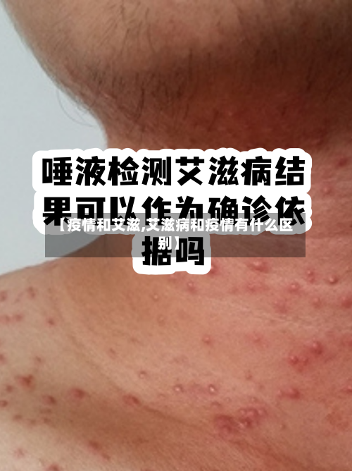 【疫情和艾滋,艾滋病和疫情有什么区别】
