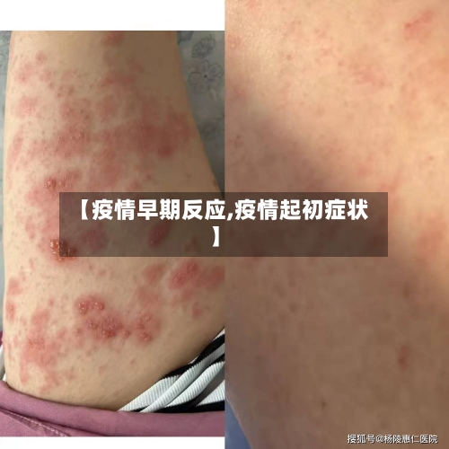 【疫情早期反应,疫情起初症状】-第1张图片