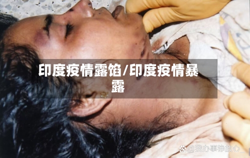 印度疫情露馅/印度疫情暴露-第1张图片