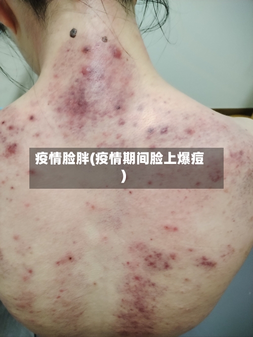 疫情脸胖(疫情期间脸上爆痘)-第1张图片