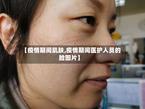 【疫情期间肌肤,疫情期间医护人员的脸图片】