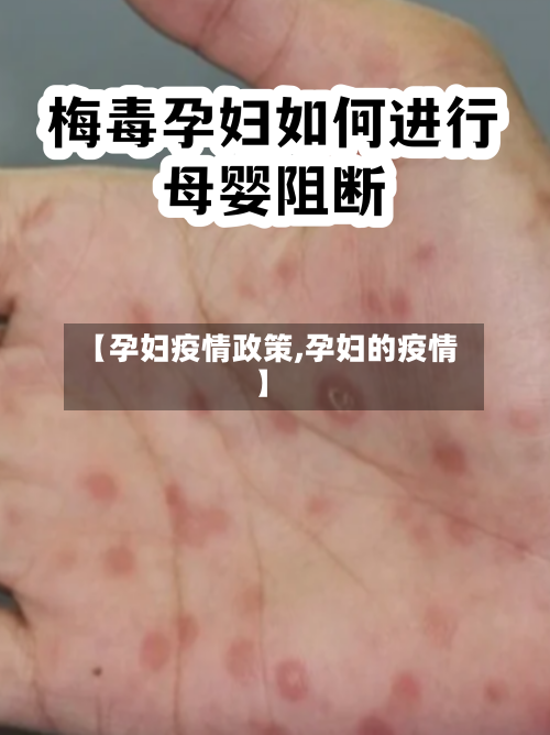 【孕妇疫情政策,孕妇的疫情】-第2张图片